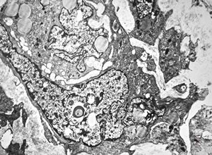 F,80y. | leiomyosarcoma - thigh